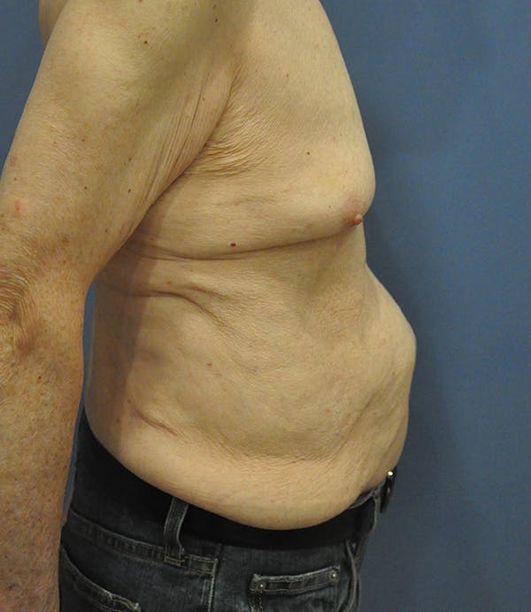 Tummy Tuck (Abdominoplasty) Before & After Gallery - Patient 21023847 - Image 3