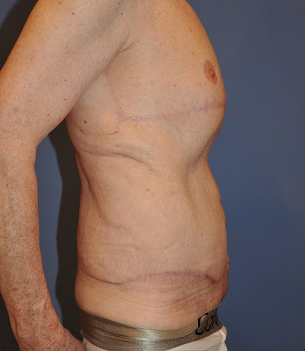 Tummy Tuck (Abdominoplasty) Before & After Gallery - Patient 21023847 - Image 4
