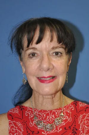 Dr. Wirth Facelift Before & After Photo in Newport Beach