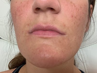 Lip Augmentation Before & After Gallery - Patient 21144012 - Image 1