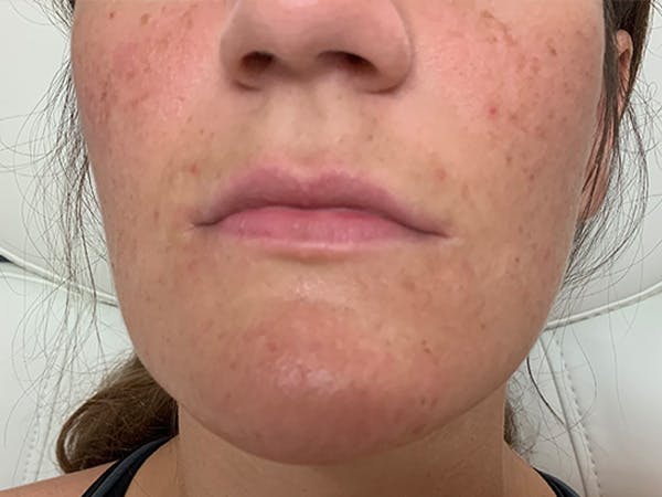 Lip Augmentation Before & After Gallery - Patient 21144012 - Image 1