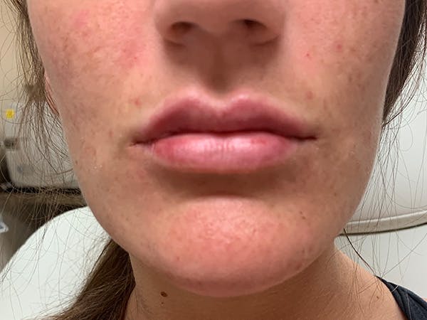 Lip Augmentation Before & After Gallery - Patient 21144012 - Image 2