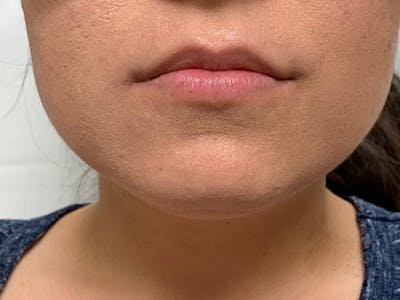 Lip Augmentation Before & After Gallery - Patient 21144050 - Image 1