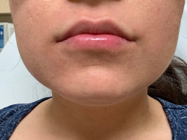 Lip Augmentation Before & After Gallery - Patient 21144050 - Image 2