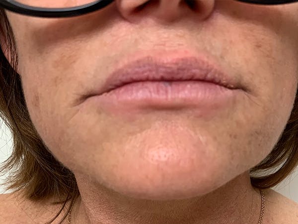 Lip Augmentation Before & After Gallery - Patient 21144063 - Image 1