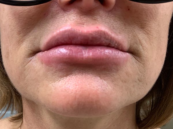 Lip Augmentation Before & After Gallery - Patient 21144063 - Image 2
