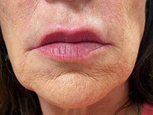Lip Augmentation Before & After Gallery - Patient 21144234 - Image 1
