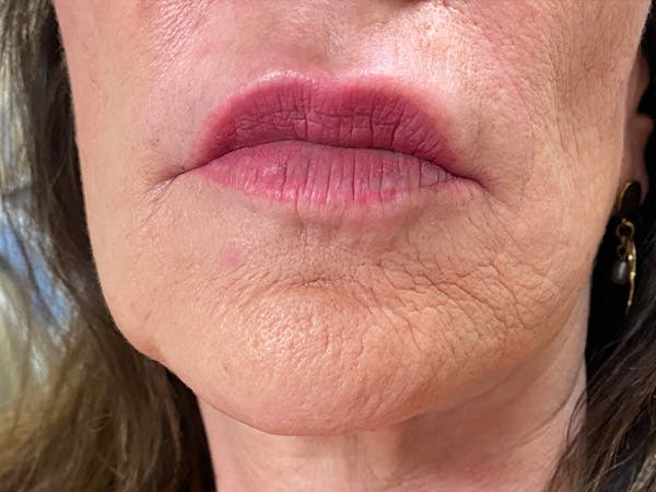 Lip Augmentation Before & After Gallery - Patient 21144234 - Image 2