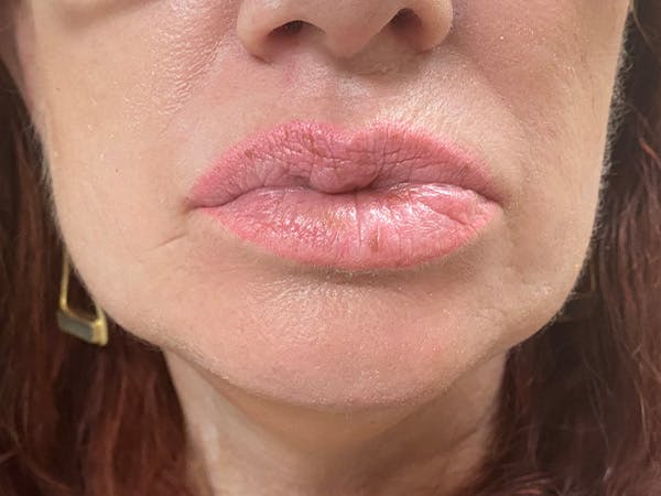 Lip Augmentation Before & After Gallery - Patient 21349556 - Image 1