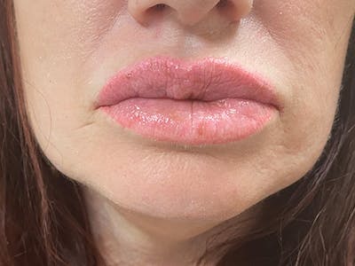 Lip Augmentation Before & After Gallery - Patient 21349556 - Image 2