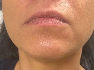 Lip Augmentation Before & After Gallery - Patient 21349587 - Image 1