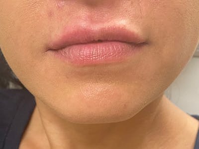 Lip Augmentation Before & After Gallery - Patient 21349587 - Image 2