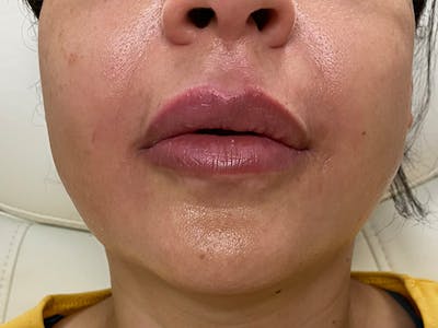 Lip Augmentation Before & After Gallery - Patient 21349668 - Image 1