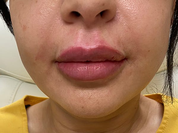 Lip Augmentation Before & After Gallery - Patient 21349668 - Image 2
