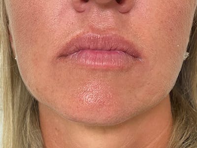 Lip Augmentation Before & After Gallery - Patient 21349720 - Image 1