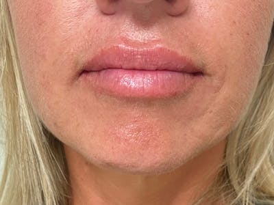 Lip Augmentation Before & After Gallery - Patient 21349720 - Image 2