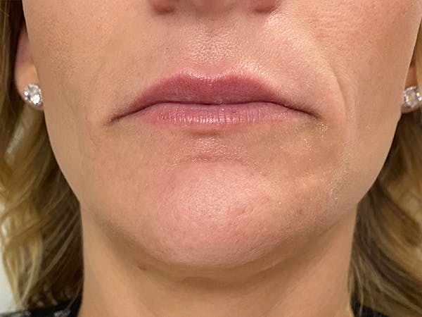 Lip Augmentation Before & After Gallery - Patient 21349824 - Image 1