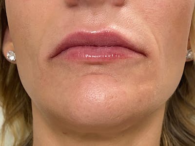 Lip Augmentation Before & After Gallery - Patient 21349824 - Image 2