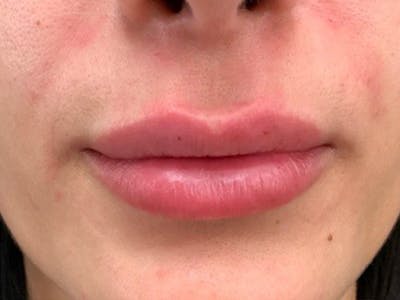Lip Augmentation Before & After Gallery - Patient 21349870 - Image 2