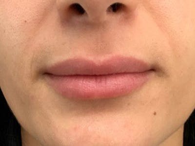 Lip Augmentation Before & After Gallery - Patient 21349870 - Image 1