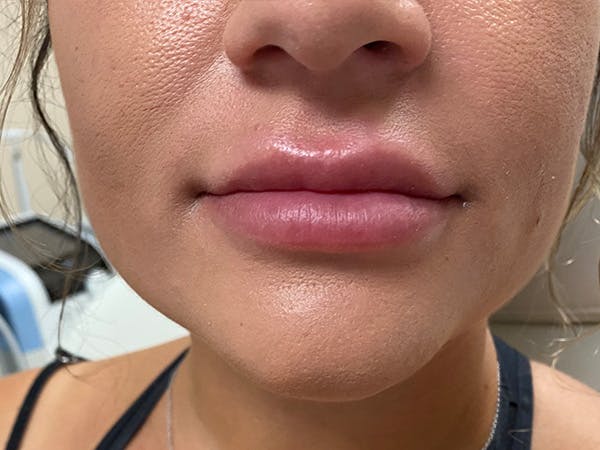 Lip Augmentation Before & After Gallery - Patient 21349903 - Image 1