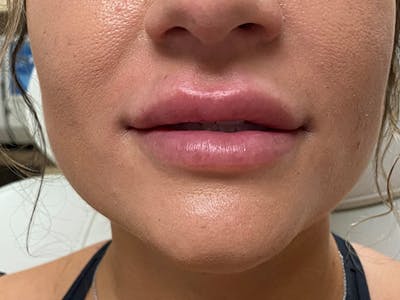Lip Augmentation Before & After Gallery - Patient 21349903 - Image 2