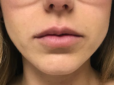 Lip Augmentation Before & After Gallery - Patient 21350048 - Image 1