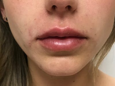 Lip Augmentation Before & After Gallery - Patient 21350048 - Image 2