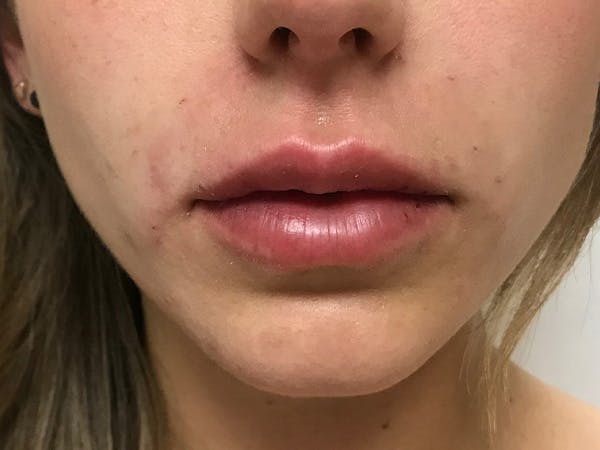 Lip Augmentation Before & After Gallery - Patient 21350048 - Image 2
