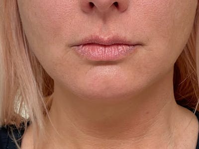 Lip Augmentation Before & After Gallery - Patient 21353116 - Image 1
