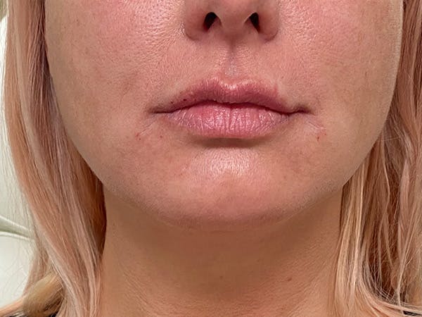 Lip Augmentation Before & After Gallery - Patient 21353116 - Image 2