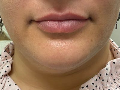Lip Augmentation Before & After Gallery - Patient 21821119 - Image 1
