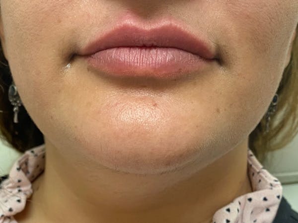 Lip Augmentation Before & After Gallery - Patient 21821119 - Image 2