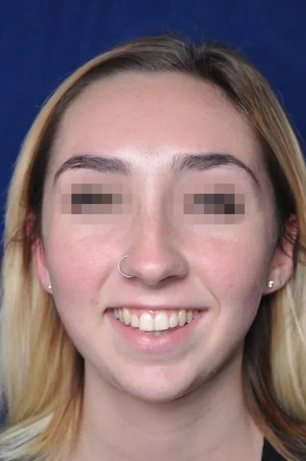 Rhinoplasty Before & After Gallery - Patient 13574719 - Image 1