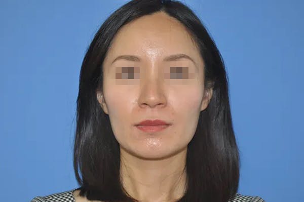 Rhinoplasty Before & After Gallery - Patient 13574721 - Image 1