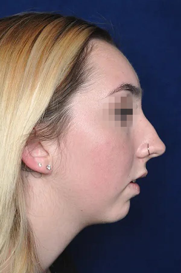 Rhinoplasty Before & After Gallery - Patient 13574719 - Image 3