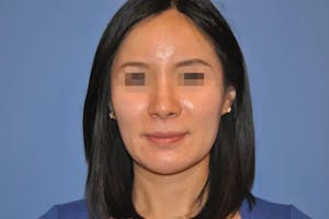 Dr. Wirth Rhinoplasty Before & After Photo in Newport Beach