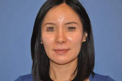 Rhinoplasty Before & After Gallery - Patient 13574721 - Image 2