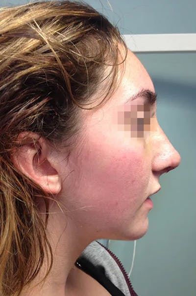 Rhinoplasty Before & After Gallery - Patient 13574719 - Image 4