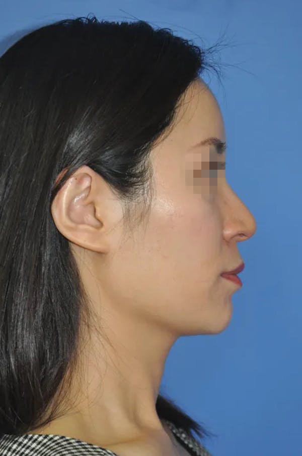 Rhinoplasty Before & After Gallery - Patient 13574721 - Image 3