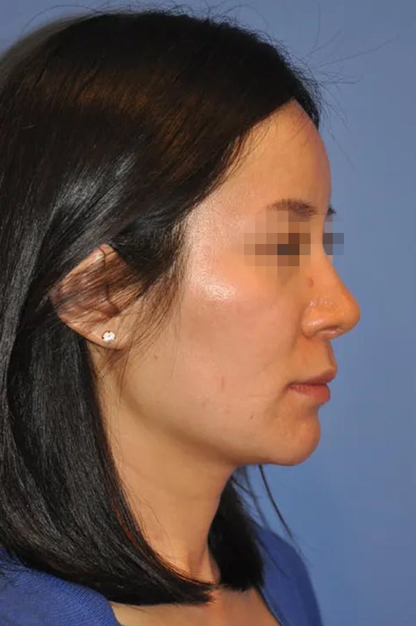 Rhinoplasty Before & After Gallery - Patient 13574721 - Image 4