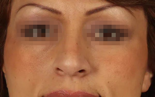 Rhinoplasty Before & After Gallery - Patient 13574723 - Image 1