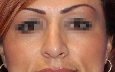 Rhinoplasty Before & After Gallery - Patient 13574723 - Image 2