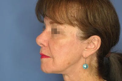 Rhinoplasty Before & After Gallery - Patient 13574724 - Image 1