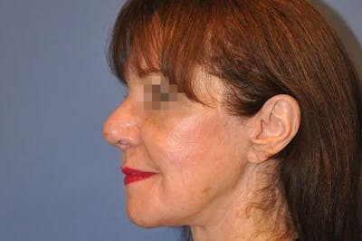 Rhinoplasty Before & After Gallery - Patient 13574724 - Image 2