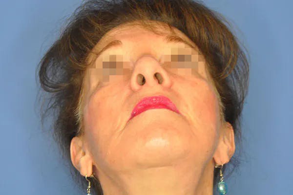 Rhinoplasty Before & After Gallery - Patient 13574724 - Image 3