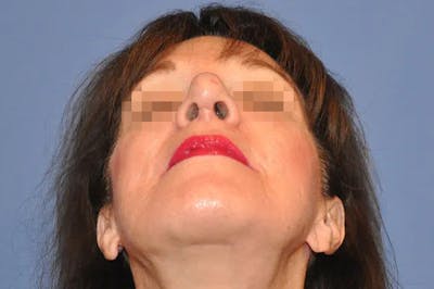 Rhinoplasty Before & After Gallery - Patient 13574724 - Image 4