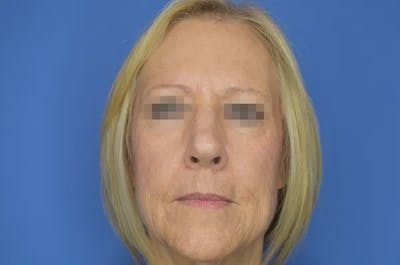 Rhinoplasty Before & After Gallery - Patient 13574726 - Image 1
