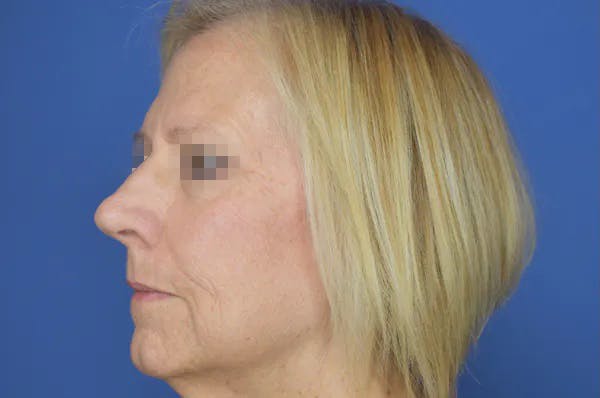 Rhinoplasty Before & After Gallery - Patient 13574726 - Image 3