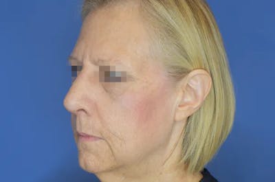 Rhinoplasty Before & After Gallery - Patient 13574726 - Image 4